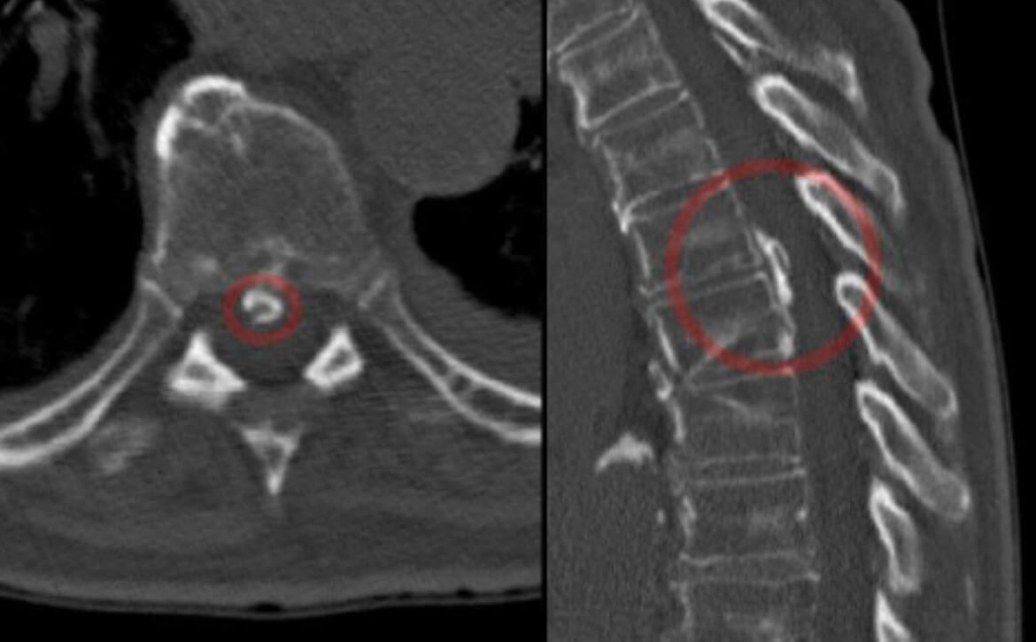Neuroapathic bladder, gastroenterologist surgeon in India